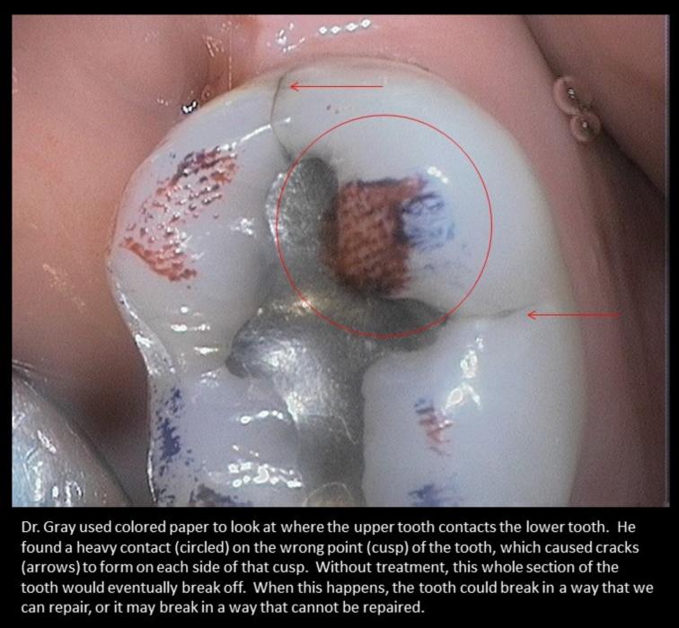 Is Your Bite Cracking Your Teeth?