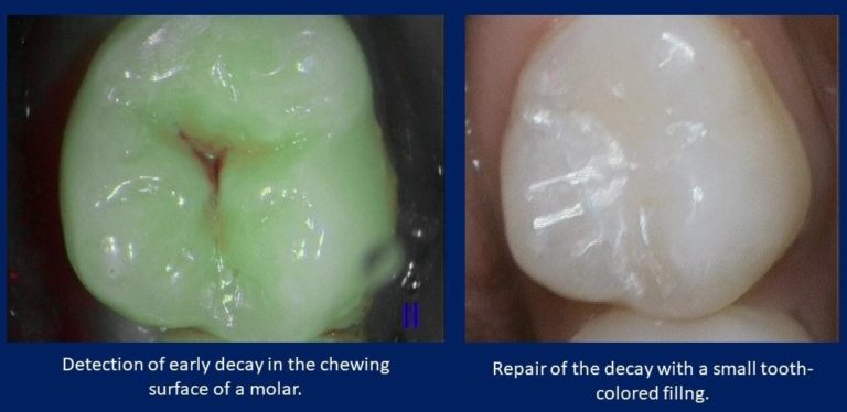 Technology Matters In Dentistry – Fluorescence Cavity Detection