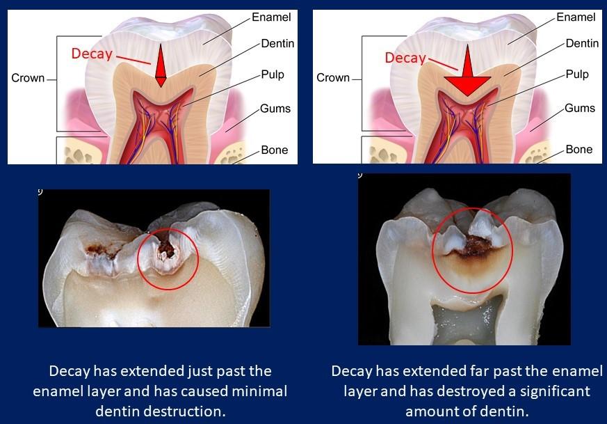 Technology Matters In Dentistry - Fluorescence Cavity Detection