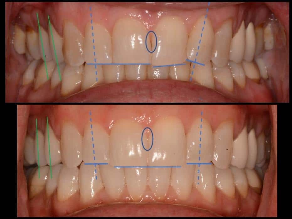 invisalign gap in front teeth