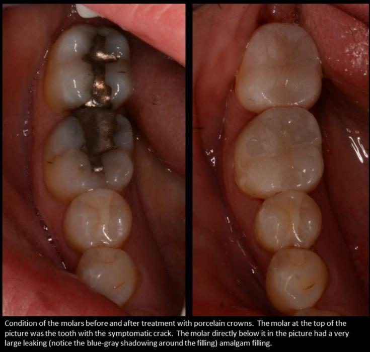 What If I Notice Cracks in My Teeth?