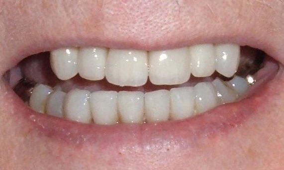 Ceramic Tooth Colored Crowns | Poudre Valley Family Dental