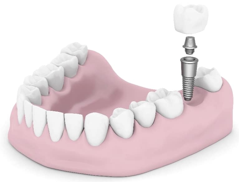 Why Dentists Recommend Dental Implants for Replacing Teeth
