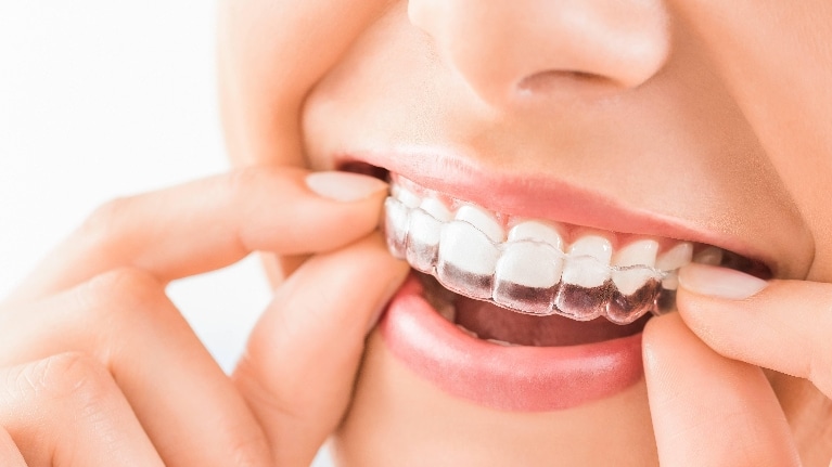 With Invisalign, Adults Can Have Straight Teeth Too