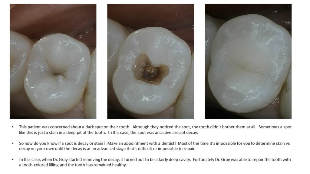 Can a Decayed Tooth Be Saved? Discover the Power of Dental Restoration