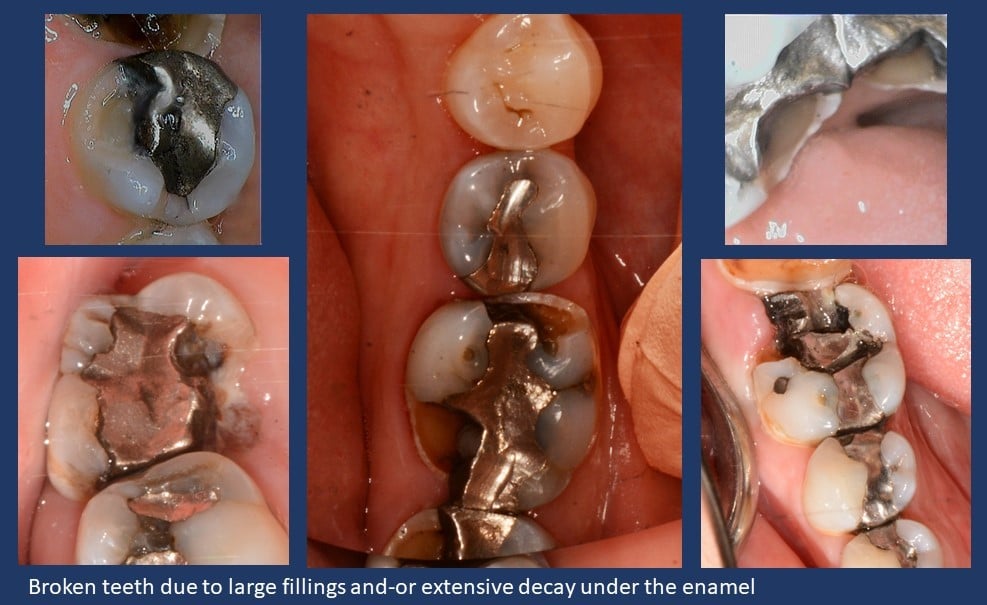 broken molar filling