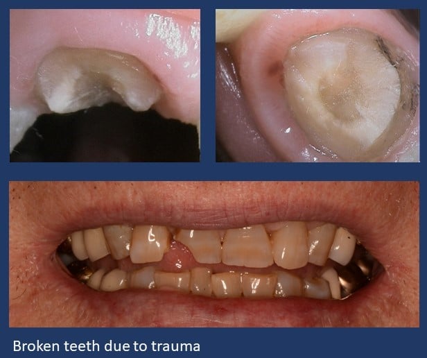 Cracked Tooth Repair - Common Causes and Fixes For Cracked Teeth, Emergency Dentist Offering Cracked Tooth Repair