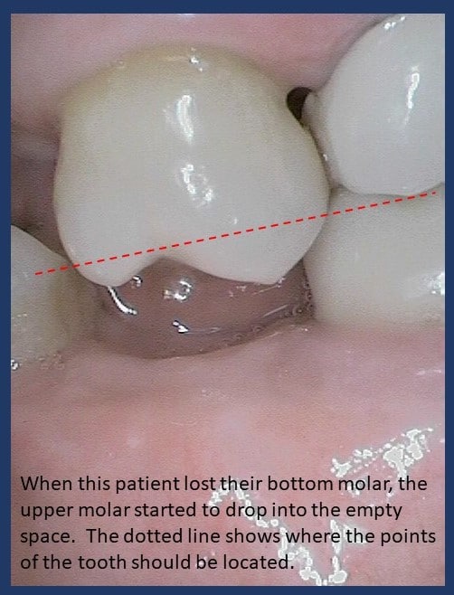 Missing Teeth | Poudre Valley Family Dental