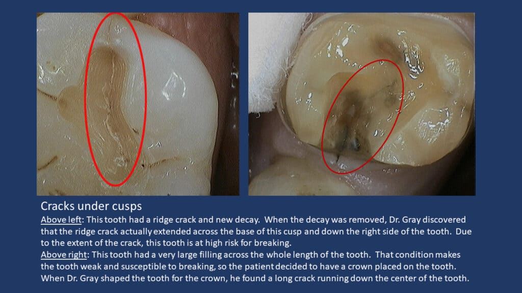 Cusp Cracks | Poudre Valley Family Dental