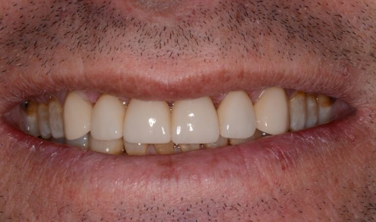 Dr. Gray’s Approach to Restoring a Functional and Beautiful Smile